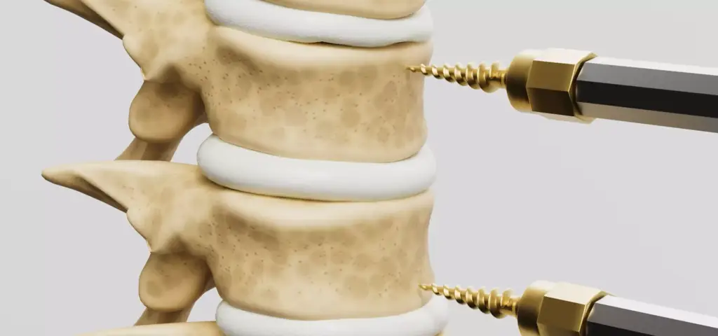 Viti inserite nelle vertebre, animazione 3D chirurgica: dettaglio della fissazione spinale