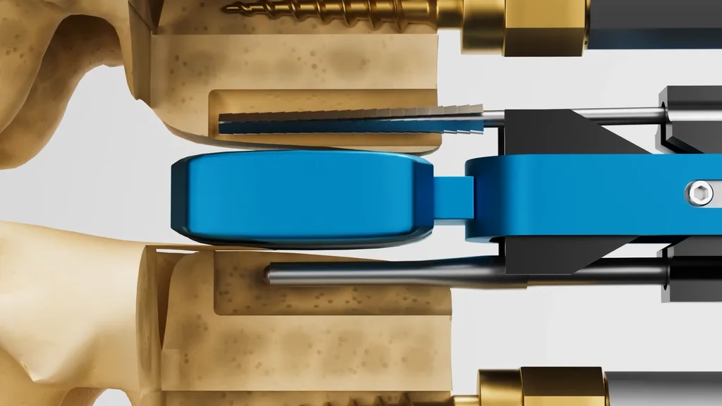Surgery animation still of spinal screw fixation