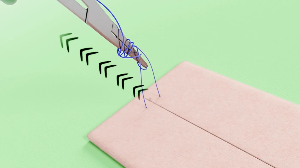 Knoop die richting de incisie wordt aangedrukt, met chevronpijlen die de richting aangeven