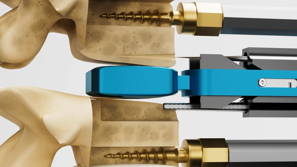 3D surgical animation still of a blue insertion tool placing an implant between vertebrae fixed with gold screws