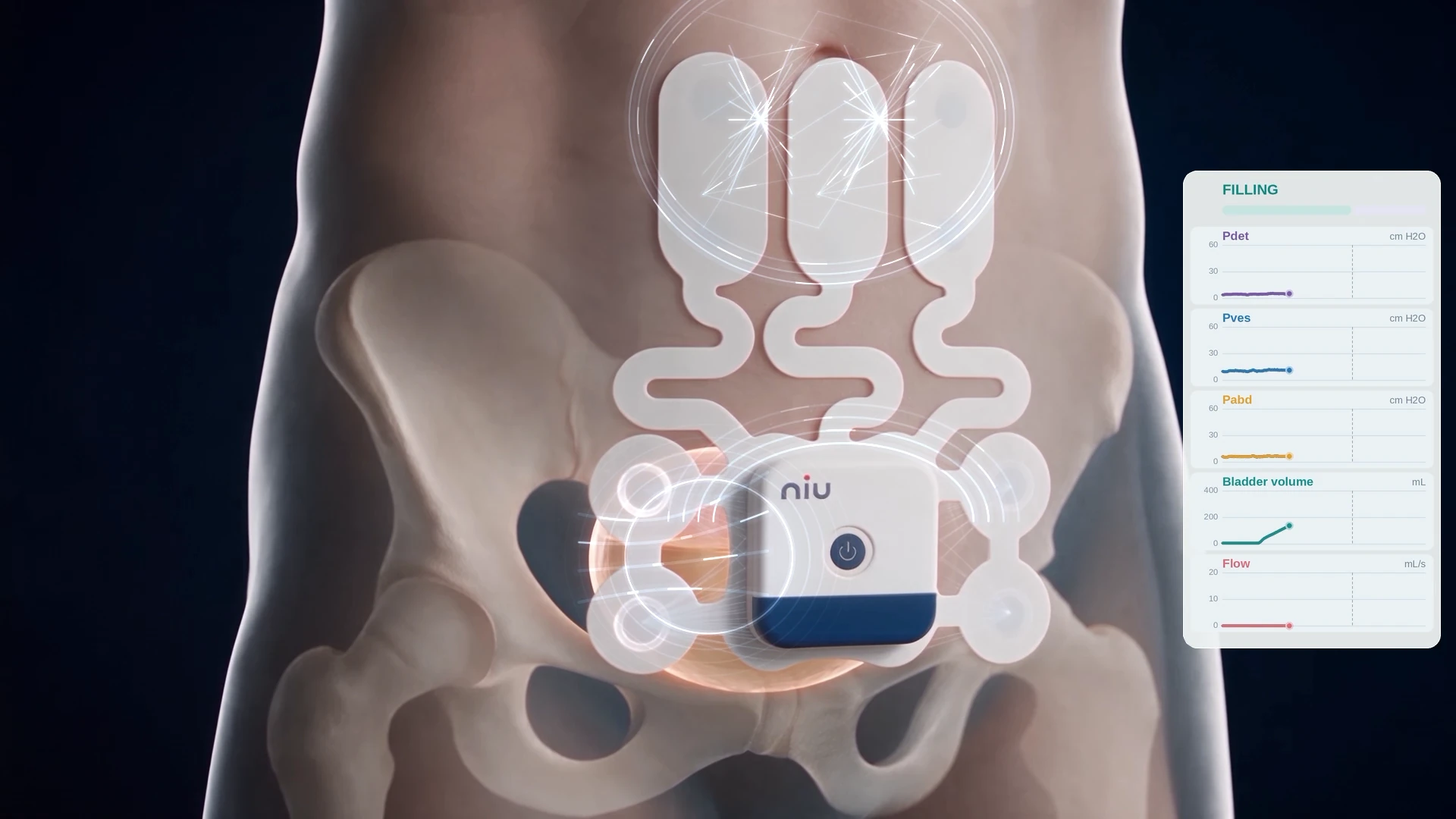 X-ray view of the bladder starting to fill under the wearable monitor, with field lines through the tissue