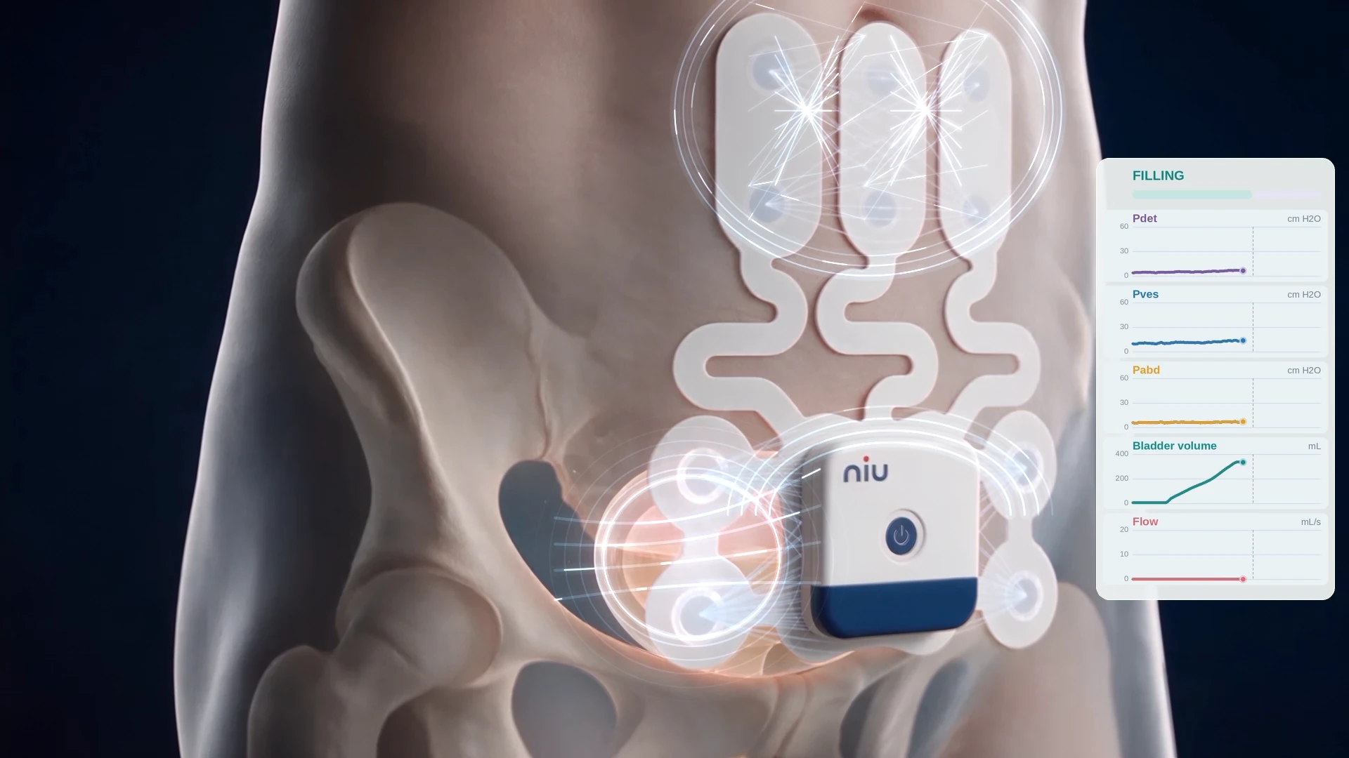 Full bladder under the wearable monitor with field lines passing through it and a rising volume trace