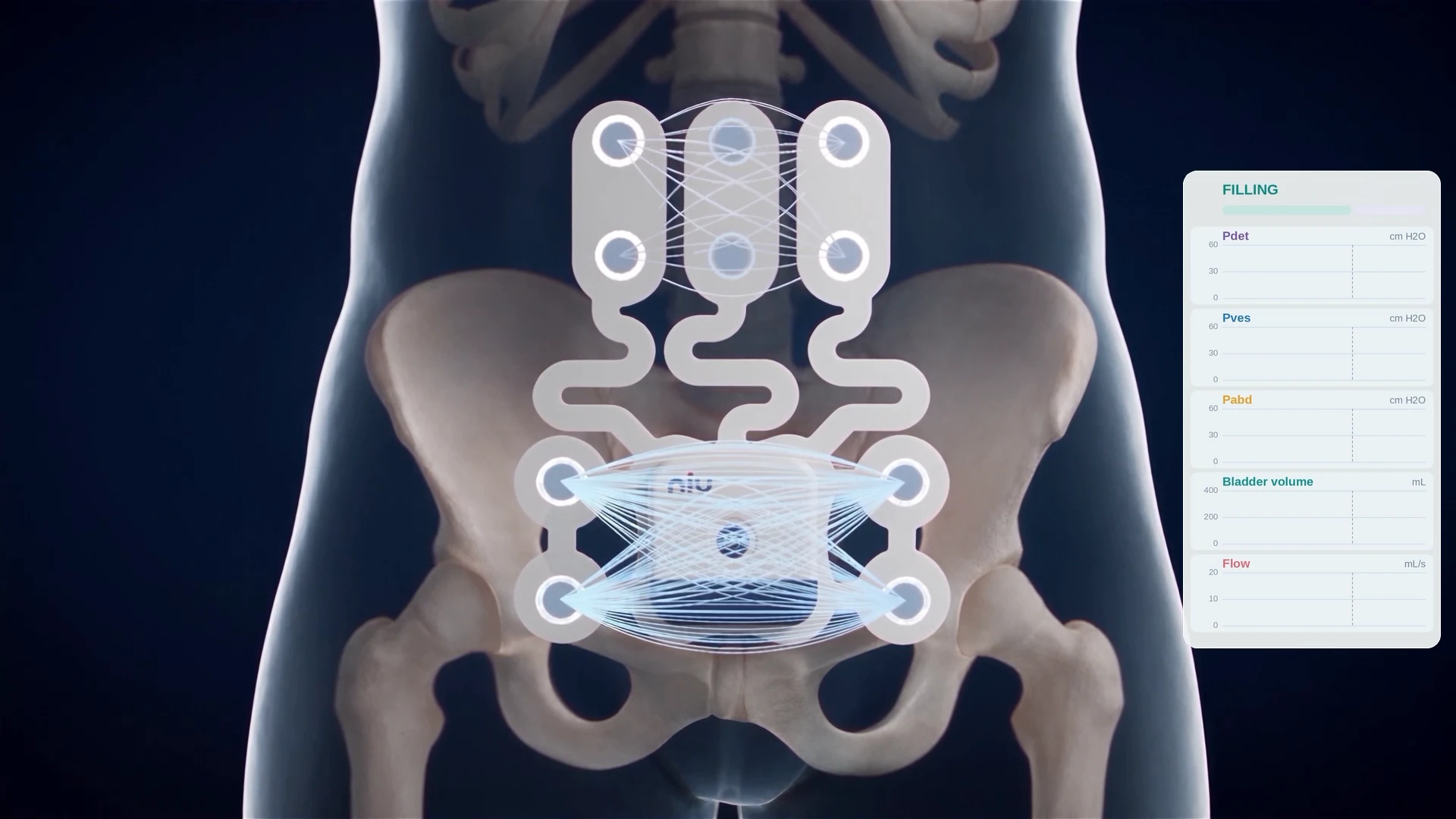 Semi-transparent pelvis with field lines between electrode sites and a reading panel in the filling phase