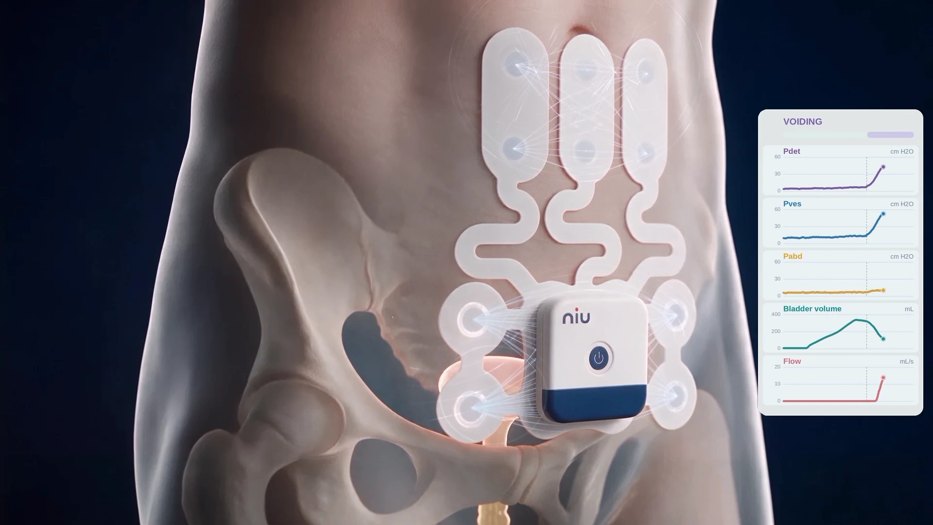 Bladder emptying under the wearable monitor, with pressure, volume and flow traces on a voiding panel