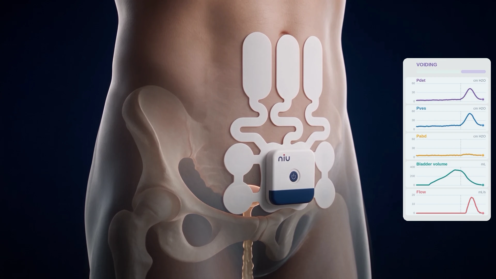 Skin returning over the pelvis after voiding, with completed pressure, volume and flow traces
