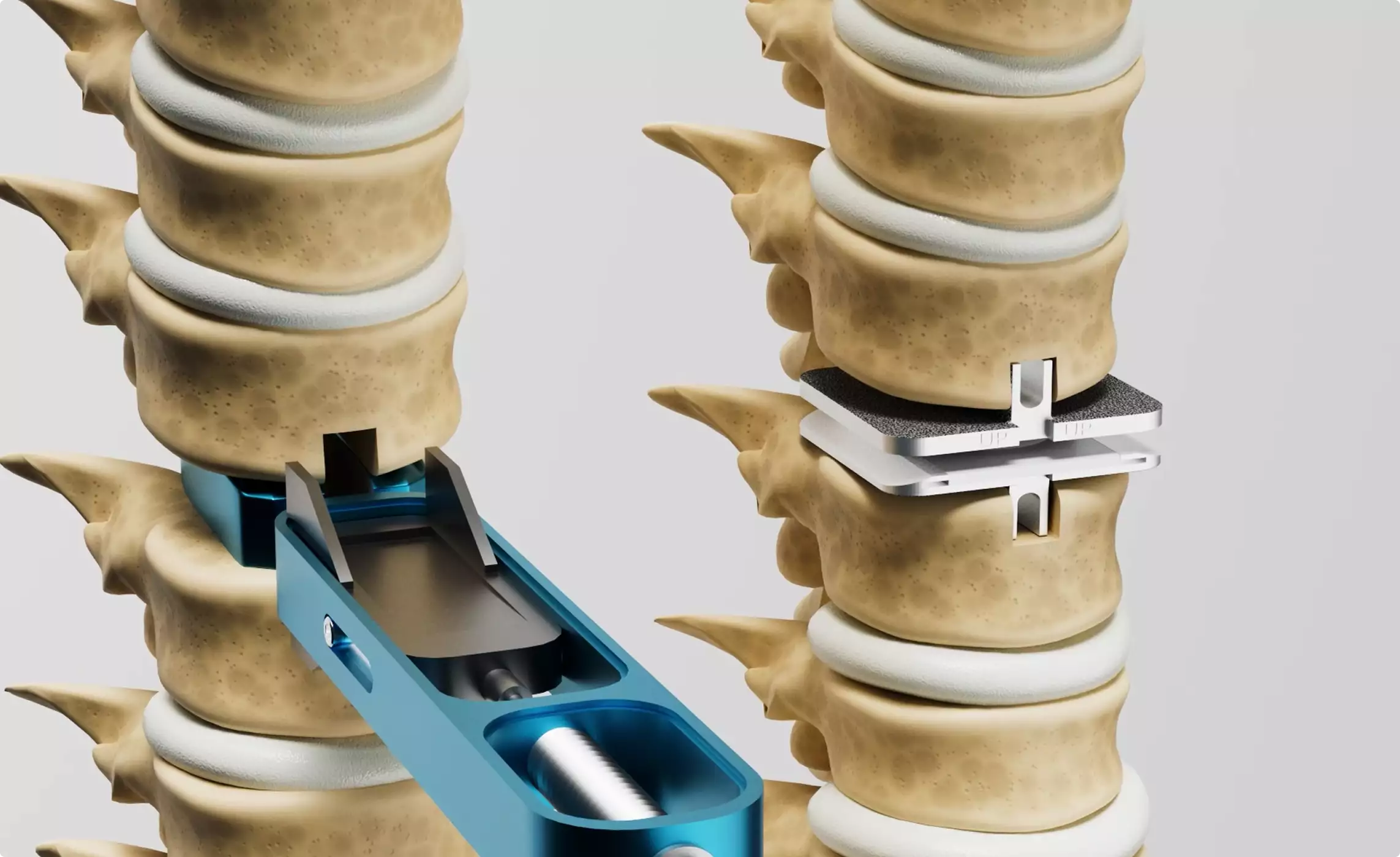 Spinal vertebrae with implant device 3D Surgery animation orthopedic structure detail