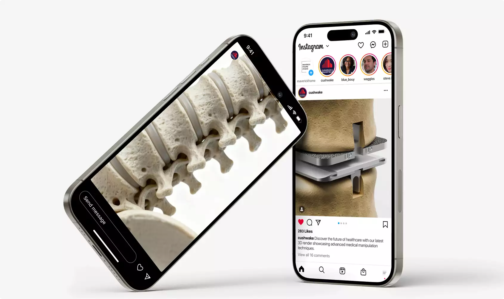 Smartphones displaying spine surgery render 3D Surgery animation social media view