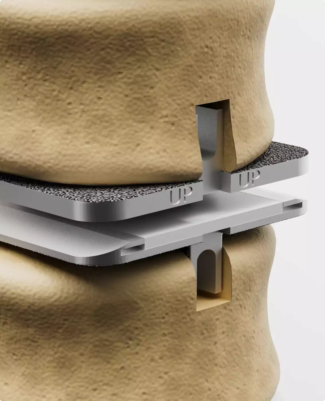 Bone fragments breaking from vertebra 3D Surgery animation surgical removal detail