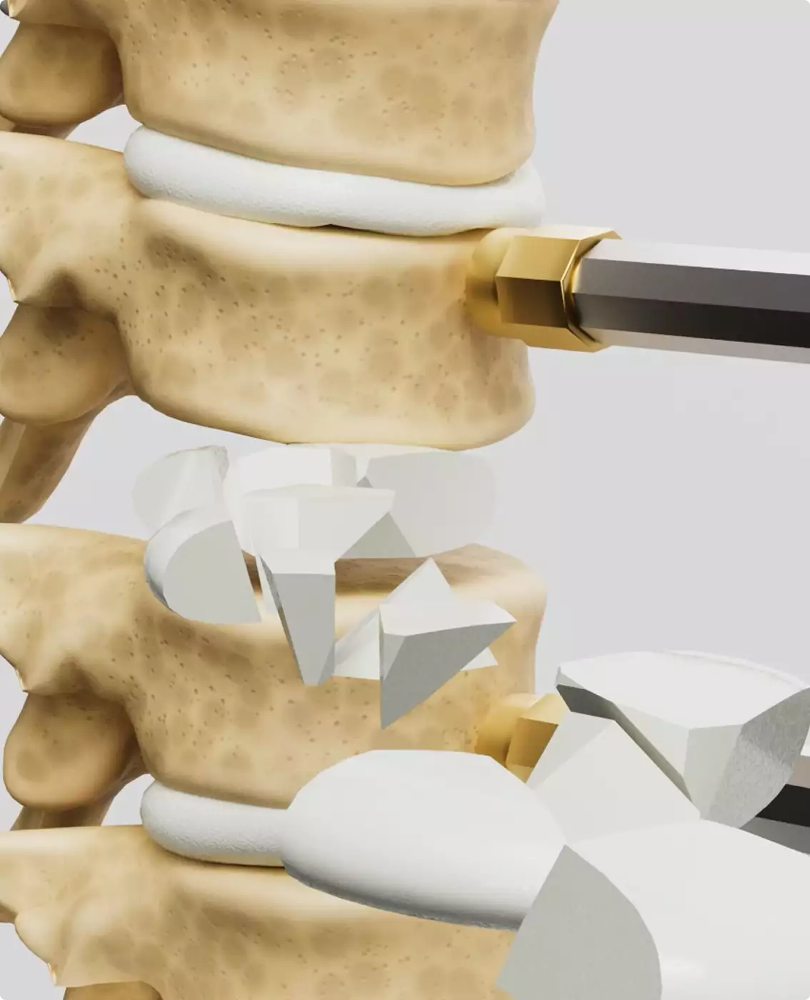 Metal surgical guide plate between vertebrae 3D Surgery animation implant positioning detail